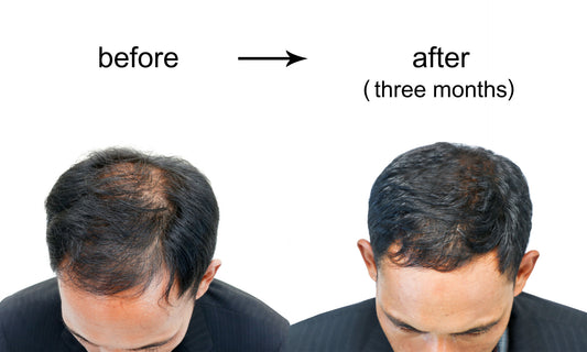 Can Bald Men Grow Hair? Insights into Possibilities and Treatments